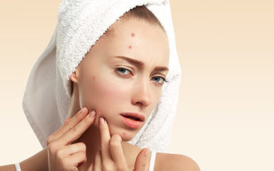 El acné: causas y tratamientos